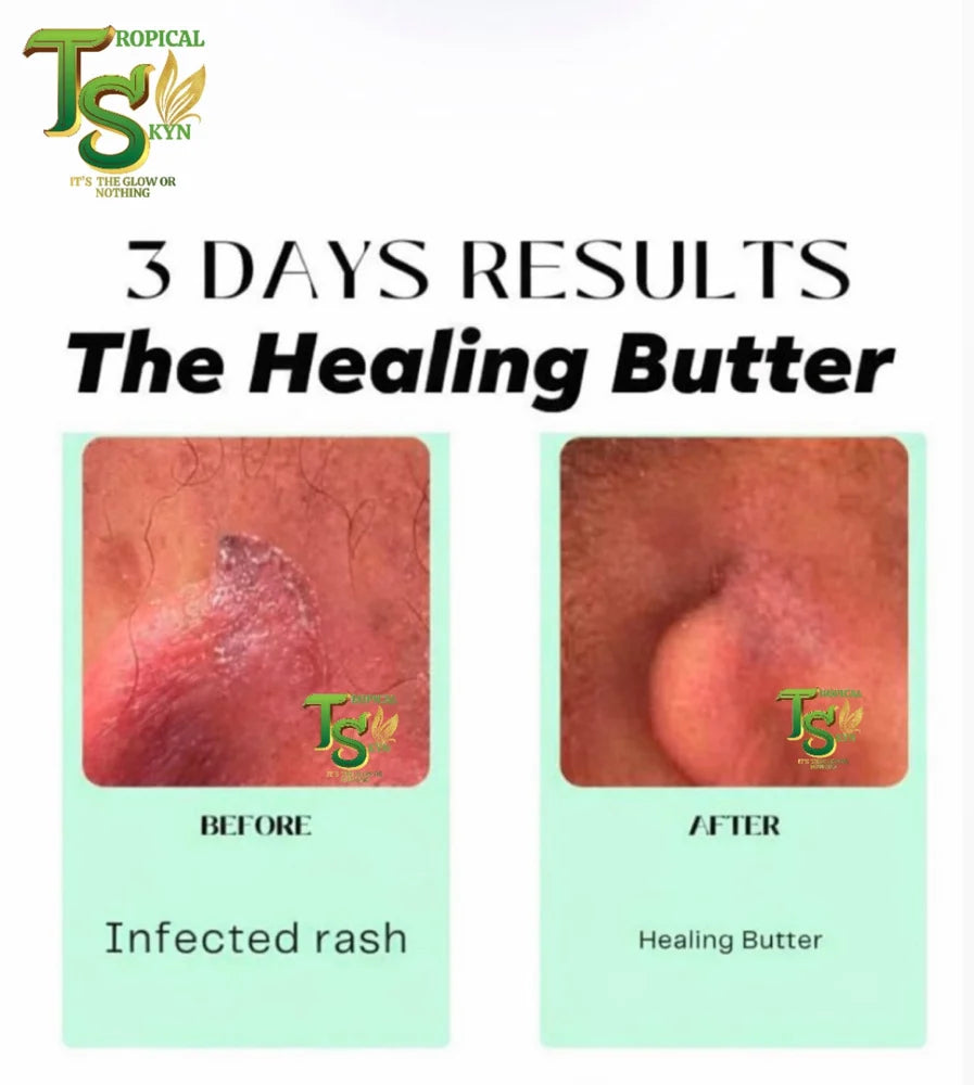 Healing Butter