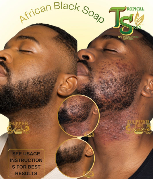 Best African Black Soap for Razor Bumps (2026): Why Tropical Skyn Outperforms Ordinary Black Soap