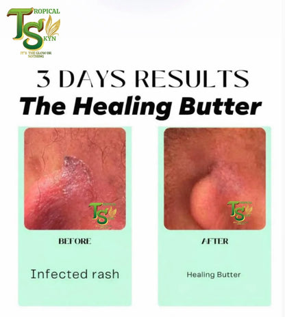 Healing Butter