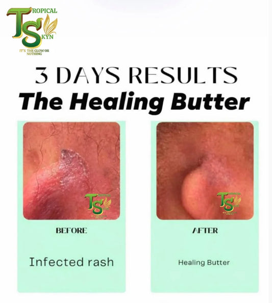 Healing Butter
