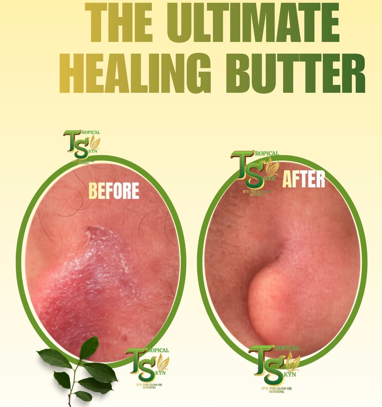 Eczema, rashes, ring worms etc