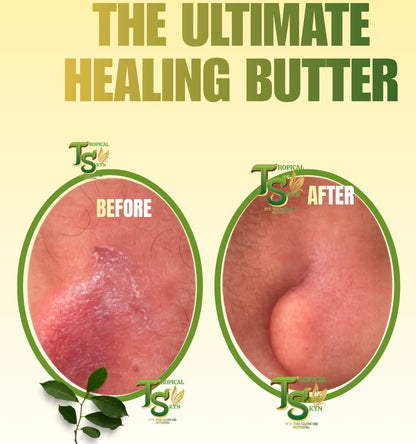 Eczema, rashes, ring worms etc